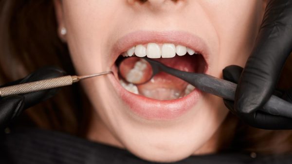 secretos sobre la candidiasis oral